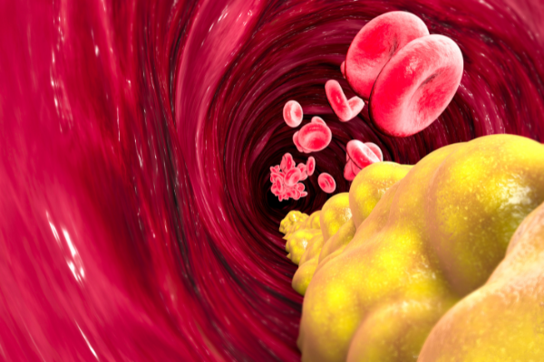 LDL Cholesterol